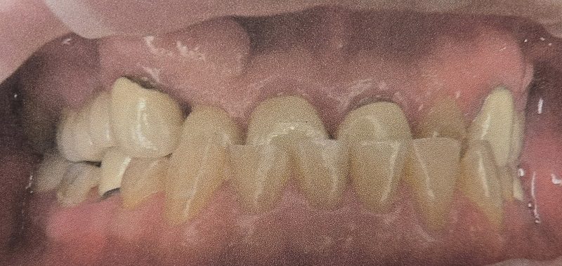 Photo of Class III maloclusion