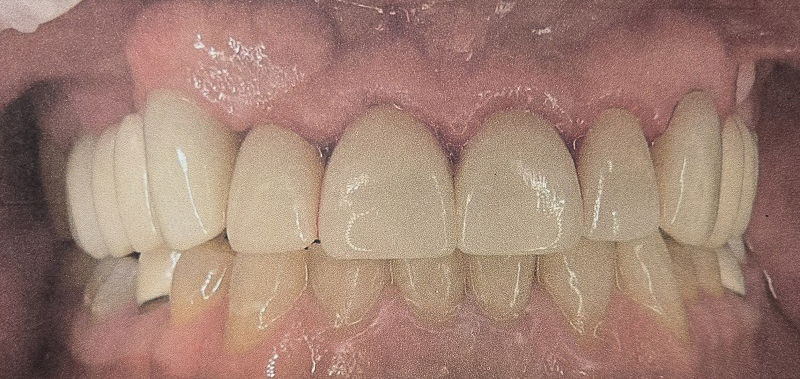 Photo of Class III maloclusion treated with invisalign and crown and bridge